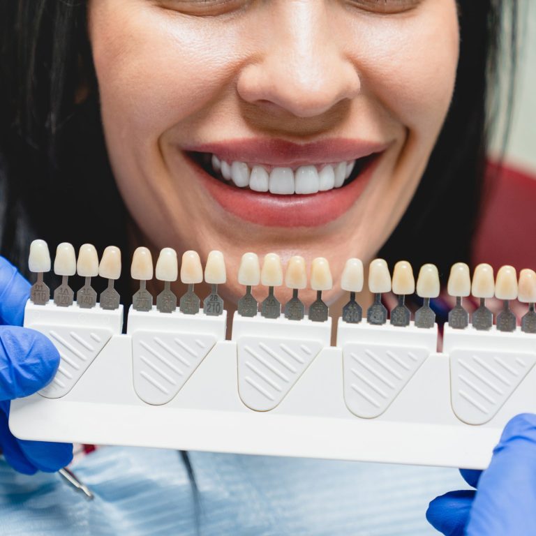 Whitening concept. Dental care, implants for veneers. Beautiful caucasian woman with perfect smile choosing teeth tooth tone at dental clinic.