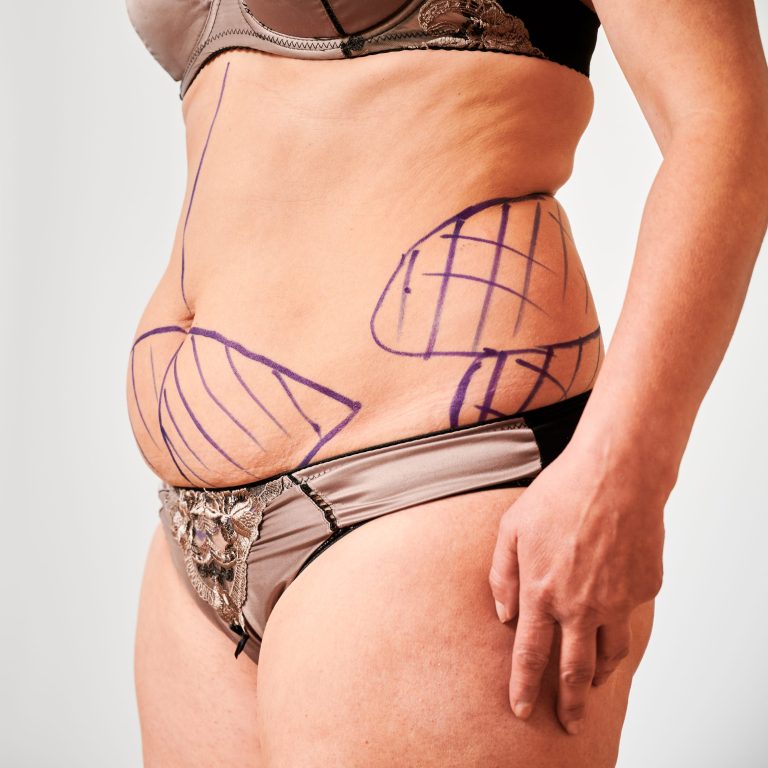 Close up of patient belly with marks for aesthetic surgery. Fat woman in underwear demonstrating results of preoperative marking procedure. Concept of overweight and preparation for plastic surgery.